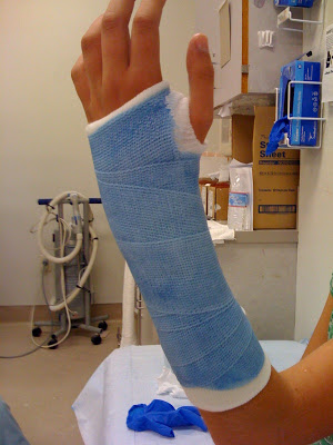 blue cast broken arm